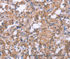 Immunohistochemistry of paraffin-embedded Human thyroid cancer tissue using GPR172B Polyclonal Antibody at dilution 1:40
