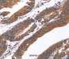 Immunohistochemistry of paraffin-embedded Human colon cancer tissue using GREB1 Polyclonal Antibody at dilution 1:40