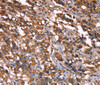 Immunohistochemistry of paraffin-embedded Human thyroid cancer tissue using GREB1 Polyclonal Antibody at dilution 1:40