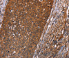 Immunohistochemistry of paraffin-embedded Human cervical cancer tissue using GUK1 Polyclonal Antibody at dilution 1:40