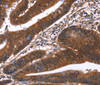Immunohistochemistry of paraffin-embedded Human colon cancer tissue using GUK1 Polyclonal Antibody at dilution 1:40