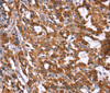 Immunohistochemistry of paraffin-embedded Human thyroid cancer tissue using HACE1 Polyclonal Antibody at dilution 1:40