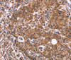 Immunohistochemistry of paraffin-embedded Human gastric cancer tissue using HACE1 Polyclonal Antibody at dilution 1:40