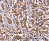 Immunohistochemistry of paraffin-embedded Human breast cancer tissue using HRG Polyclonal Antibody at dilution 1:50