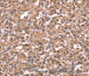 Immunohistochemistry of paraffin-embedded Human thyroid cancer using Histamine H1 Receptor Polyclonal Antibody at dilution of 1:40