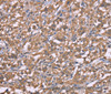 Immunohistochemistry of paraffin-embedded Human thyroid cancer using Histamine H3 Receptor Polyclonal Antibody at dilution of 1:50