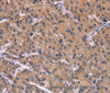 Immunohistochemistry of paraffin-embedded Human prostate cancer tissue using HSD11B2 Polyclonal Antibody at dilution 1:35