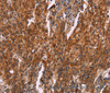 Immunohistochemistry of paraffin-embedded Human gastric cancer tissue using HSPB6 Polyclonal Antibody at dilution 1:30