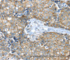 Immunohistochemistry of paraffin-embedded Human gasrtic cancer tissue using IFNA2 Polyclonal Antibody at dilution 1:40