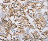 Immunohistochemistry of paraffin-embedded Human thyroid cancer tissue using IL12RB2 Polyclonal Antibody at dilution 1:40