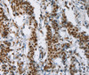 Immunohistochemistry of paraffin-embedded Human gastic cancer using IL17C Polyclonal Antibody at dilution of 1:50