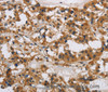Immunohistochemistry of paraffin-embedded Human thyroid cancer tissue using IL17RB Polyclonal Antibody at dilution 1:40