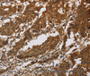 Immunohistochemistry of paraffin-embedded Human gastric cancer tissue using IL17RB Polyclonal Antibody at dilution 1:40