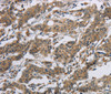 Immunohistochemistry of paraffin-embedded Human gastic cancer using SYN2 Polyclonal Antibody at dilution of 1:40