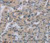 Immunohistochemistry of paraffin-embedded Human liver cancer using SYN2 Polyclonal Antibody at dilution of 1:40