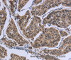 Immunohistochemistry of paraffin-embedded Human breast cancer tissue using IPO8 Polyclonal Antibody at dilution 1:50