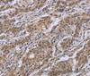 Immunohistochemistry of paraffin-embedded Human gastric cancer tissue using IPO8 Polyclonal Antibody at dilution 1:50