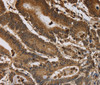 Immunohistochemistry of paraffin-embedded Human colon cancer tissue using ITPR3 Polyclonal Antibody at dilution 1:40