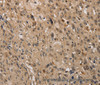 Immunohistochemistry of paraffin-embedded Human esophagus cancer using KDM4A Polyclonal Antibody at dilution of 1:40