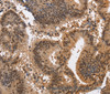 Immunohistochemistry of paraffin-embedded Human colon cancer using KCNG2 Polyclonal Antibody at dilution of 1:40