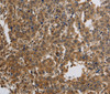 Immunohistochemistry of paraffin-embedded Human liver cancer using KCNMB4 Polyclonal Antibody at dilution of 1:40