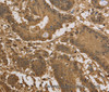 Immunohistochemistry of paraffin-embedded Human colon cancer tissue using KDM5B Polyclonal Antibody at dilution 1:40