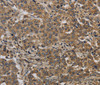 Immunohistochemistry of paraffin-embedded Human liver cancer tissue using KIF4A Polyclonal Antibody at dilution 1:40