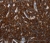 Immunohistochemistry of paraffin-embedded Human ovarian cancer tissue using KISS1R Polyclonal Antibody at dilution 1:30