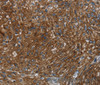 Immunohistochemistry of paraffin-embedded Human esophagus cancer tissue using KISS1R Polyclonal Antibody at dilution 1:30