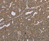 Immunohistochemistry of paraffin-embedded Human ovarian cancer using CERS4 Polyclonal Antibody at dilution of 1:35