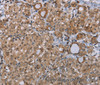 Immunohistochemistry of paraffin-embedded Human thyroid cancer tissue using LIMK1 Polyclonal Antibody at dilution 1:40