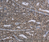 Immunohistochemistry of paraffin-embedded Human ovarian cancer tissue using MAGEC1 Polyclonal Antibody at dilution 1:30