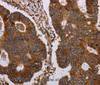 Immunohistochemistry of paraffin-embedded Human colon cancer tissue using MAGEC2 Polyclonal Antibody at dilution 1:40