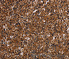Immunohistochemistry of paraffin-embedded Human liver cancer tissue using MAGEC2 Polyclonal Antibody at dilution 1:40