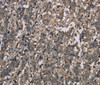 Immunohistochemistry of paraffin-embedded Human liver cancer tissue using MCC Polyclonal Antibody at dilution 1:30