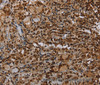 Immunohistochemistry of paraffin-embedded Human thyroid cancer using TBX5 Polyclonal Antibody at dilution of 1:35