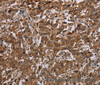 Immunohistochemistry of paraffin-embedded Human liver cancer using TBX5 Polyclonal Antibody at dilution of 1:35