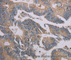 Immunohistochemistry of paraffin-embedded Human colon cancer using MMP20 Polyclonal Antibody at dilution of 1:40