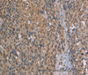 Immunohistochemistry of paraffin-embedded Human cervical cancer using CAB39 Polyclonal Antibody at dilution of 1:50