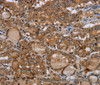 Immunohistochemistry of paraffin-embedded Human thyroid cancer using MT-ND1 Polyclonal Antibody at dilution of 1:50