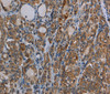 Immunohistochemistry of paraffin-embedded Human thyroid cancer tissue using MYO7A Polyclonal Antibody at dilution 1:30