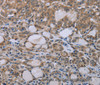 Immunohistochemistry of paraffin-embedded Human thyroid cancer tissue using NAIP Polyclonal Antibody at dilution 1:30