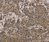 Immunohistochemistry of paraffin-embedded Human liver cancer tissue using NLRP4 Polyclonal Antibody at dilution 1:40