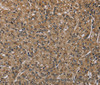 Immunohistochemistry of paraffin-embedded Human prostate cancer tissue using NLRP4 Polyclonal Antibody at dilution 1:40