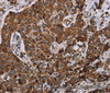 Immunohistochemistry of paraffin-embedded Human liver cancer using NDUFA4 Polyclonal Antibody at dilution of 1:40