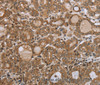 Immunohistochemistry of paraffin-embedded Human thyroid cancer using NDUFS2 Polyclonal Antibody at dilution of 1:35