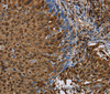 Immunohistochemistry of paraffin-embedded Human cervical cancer tissue using NRP2 Polyclonal Antibody at dilution 1:45