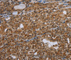 Immunohistochemistry of paraffin-embedded Human thyroid cancer tissue using UHRF2 Polyclonal Antibody at dilution 1:40