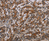 Immunohistochemistry of paraffin-embedded Human liver cancer tissue using NLRP9 Polyclonal Antibody at dilution 1:40