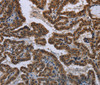 Immunohistochemistry of paraffin-embedded Human gastric cancer tissue using MYCN Polyclonal Antibody at dilution 1:35